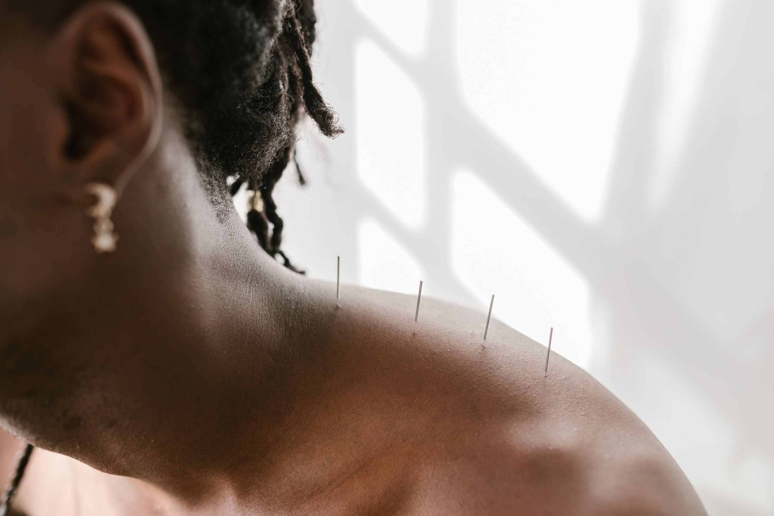 An artistic, close-up imagine of a man who has acupuncture needles in his trapezius muscle